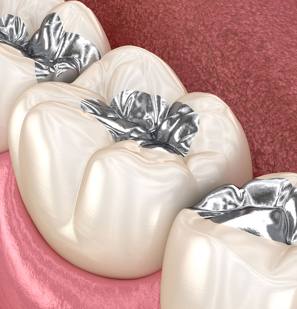 illustration of amalgam tooth