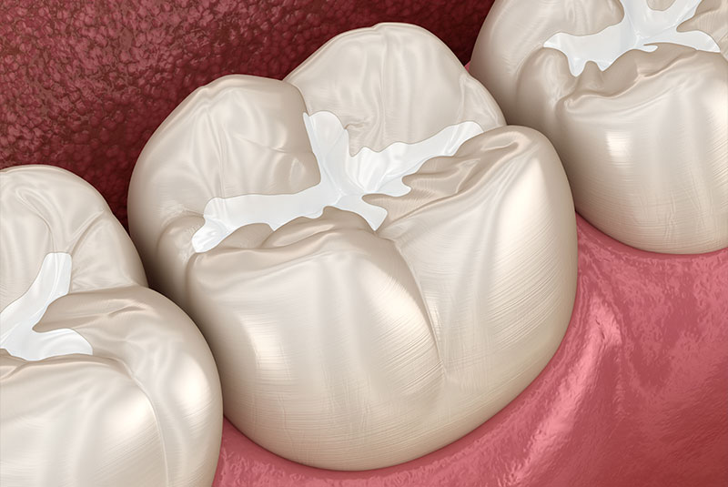 Tooth-Colored Fillings Naples FL
