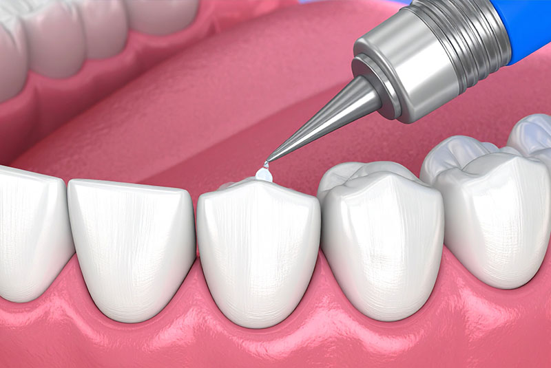 Dental Sealants Naples FL