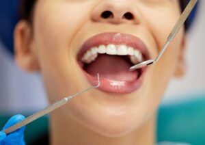 A person with their mouth open at a dental exam; a gloved hand holds dental instruments near their clean teeth. The focus is on the mouth, showing healthy gums and teeth.