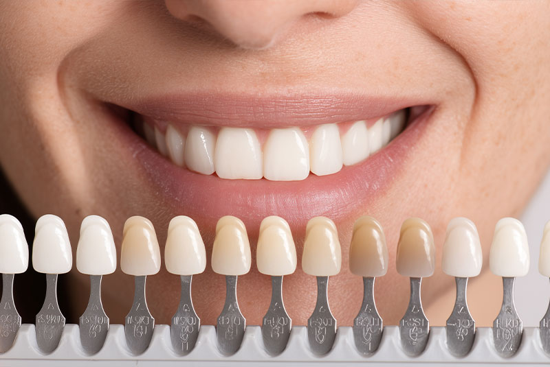 Smiling person showing teeth next to dental shade guide for color matching