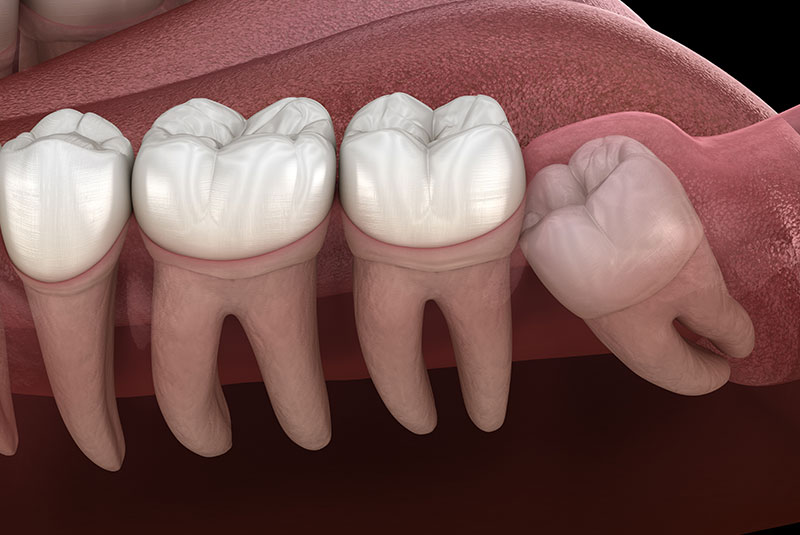 Wisdom tooth with impaction at molar tooth. Medically accurate tooth 3D illustration