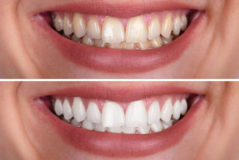teeth whitening