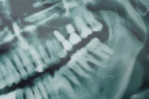 Dental X-ray showing a side view of the jaw with visible teeth and two dental implants with screws in the upper jaw, surrounded by natural teeth and jawbone structures.