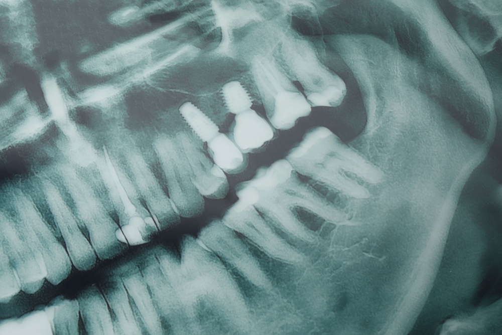Dental X-ray showing a side view of the jaw with visible teeth and two dental implants with screws in the upper jaw, surrounded by natural teeth and jawbone structures.